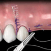 Aiguilles de suture "Perma-sharp" C22 résorbables - Hu-Friedy – Image 3